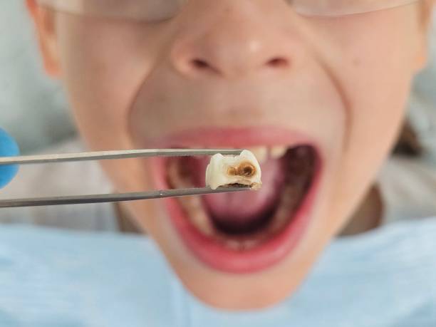 Best Emergency Treatment for Dental Infections or Abscesses in Warner, OK